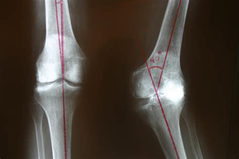 Valgus Knee Arthritis Dr Stuart Kozinn Md Totalkneeorg Dr