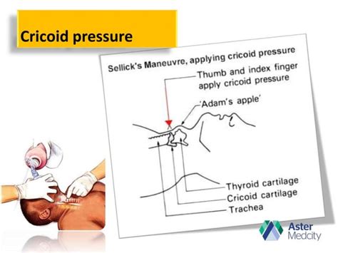 Cricoid Pressure Yes Or No