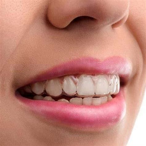 You Must Wear Your Invisalign Aligners Constantly Ooli Orthodontics
