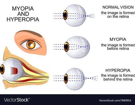 Myopia Pictures