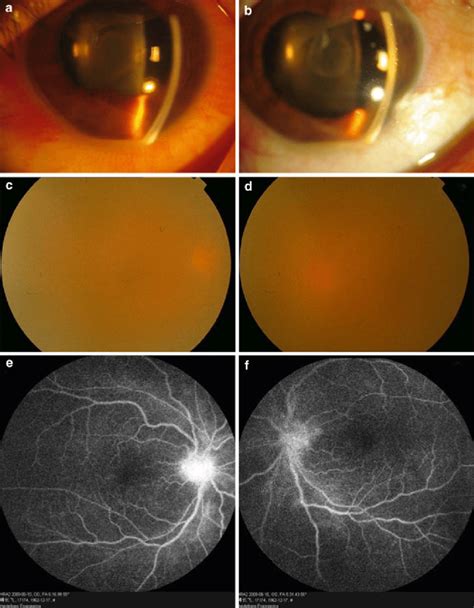 Slit Lamp Examination Vitreous Opacity And Optic Disc Exudation Prior