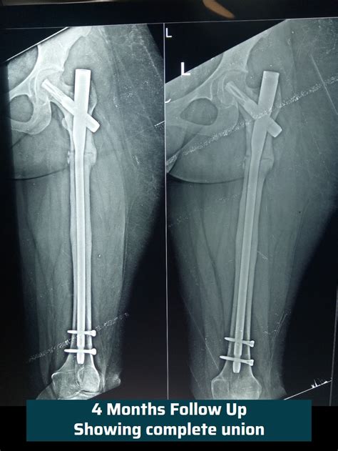 Orthopedic Trauma Fracture Treatment Ahmedabad Dr Rachit Sheth