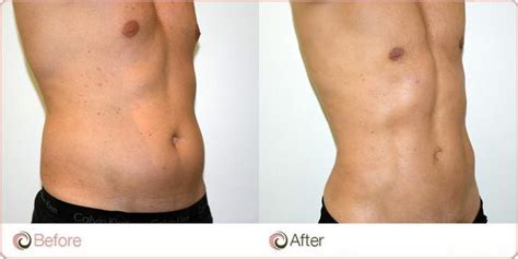 Stomach Liposuction What You Should Know Tummy Tucks In Singapore