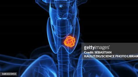 Hashimotos Thyroiditis Photos And Premium High Res Pictures Getty Images