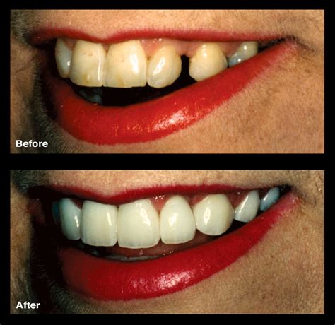 How to fix diastema with braces. Fix Gap Spaces | Teeth Bands | Oppenheim Signature Smiles