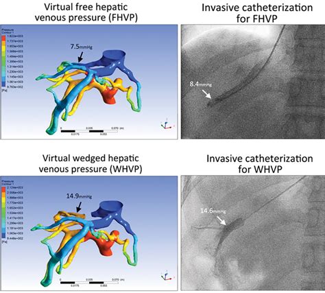 Virtual Hepatic Venous Pressure Gradient With Ct Angiography Chess