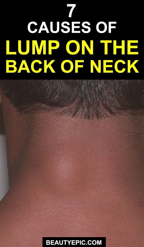Causes For Lump On The Back Of Neck Neck Skin Bumps Epidermoid Cyst