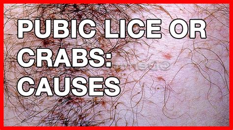 Pediculosis And Pubic Lice Symptoms Signs And Remedies Youtube