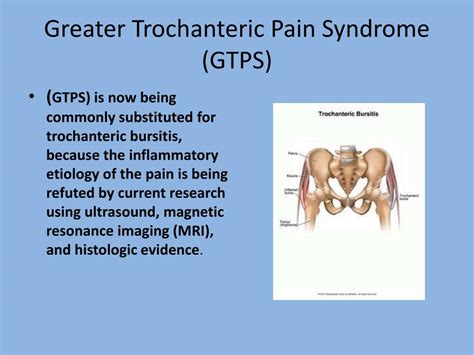Ppt Greater Trochanteric Pain Syndrome Gtps Also Known As