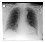 However, this finding may be due to other disorders. The calcium sign is a finding on a chest X-ray that ...