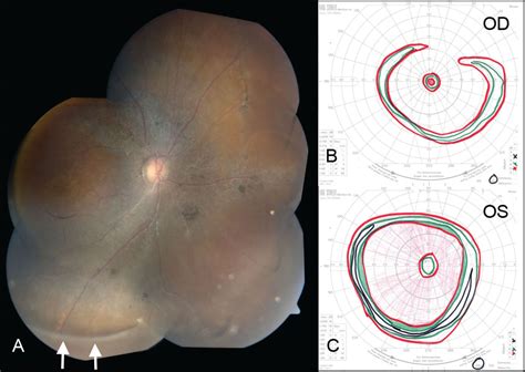 Multimodal Imaging In Wagner Syndrome