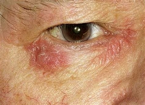 Red Circles Around Eyes Causes Remedies Get Rid Of Redness Symptoms