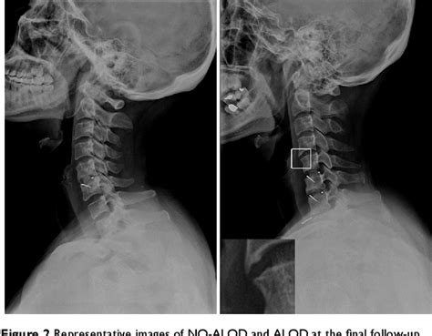 Figure 2 From Cervical Sagittal Alignment As A Predictor Of Adjacent