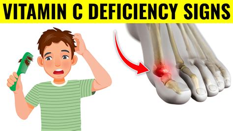 Signs Of Vitamin C Deficiency And What To Do Against It