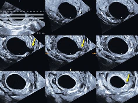 Tomographic Ultrasound Imaging Tui Is Also Of Extraordinary