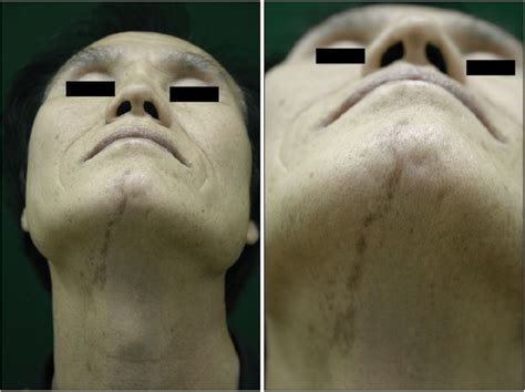 Linear Streaks Of Dark Brown Patches From The Chin And Across The Neck