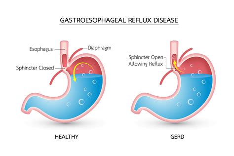 How To Treat Cough From Gerd Gastric Reflux Treatment