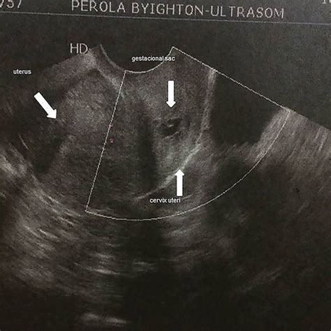 Transvaginal Ultrasonography Identifying The Ectopic Pregnancy