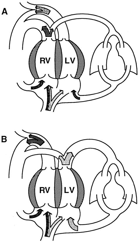 Prenatal Features Of Ductus Arteriosus Constriction And Restrictive