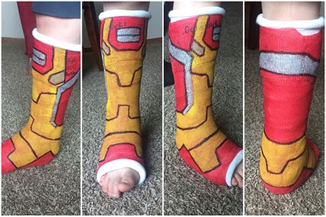 Leg cast design ideas. Iron Man boot. Cool cast ideas. Making casts more fun! | Leg cast, Cast 