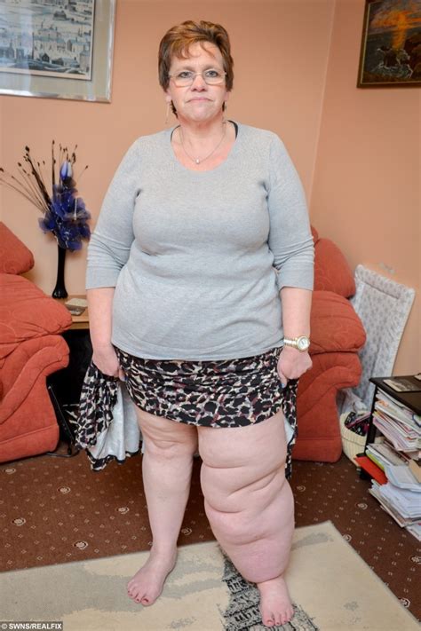 Finally Help For The Cancer Survivor With A Leg Three Stone Heavier