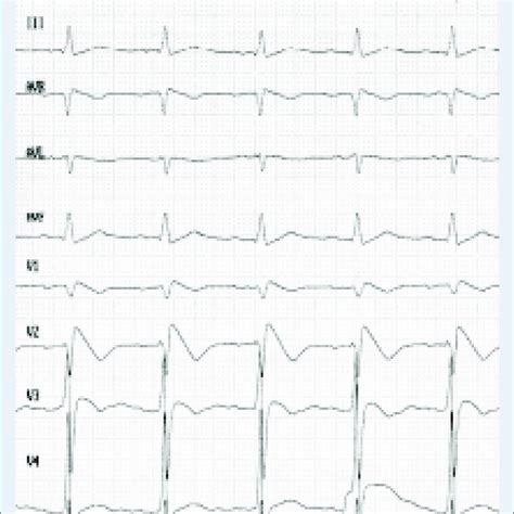 Twelve Lead Electrocardiogram Showing Normal Sinus Rhythm And Typical