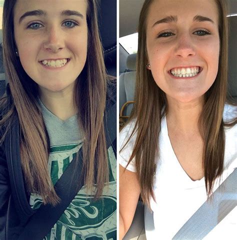 Incredible Before And After Transformations Of People Who Wore Braces