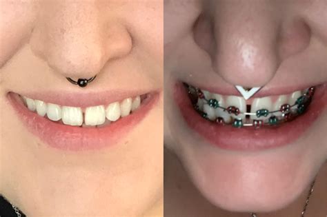 Gaps In Teeth Before And After Braces Teeth Poster