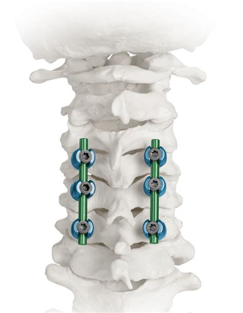 Posterior Cervical Fusion Procedure Globus Medical