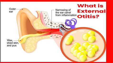 External Otitis Causes And Its Types Symptoms And Treatment