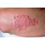 Psoriasis On Elbow Photograph By Dr P Marazzi/science Photo Library