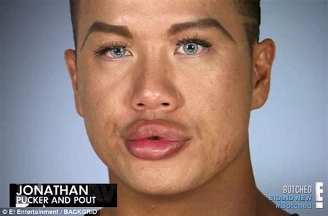 Botched Jonathan Asks For More Lip Injections Daily Mail Online