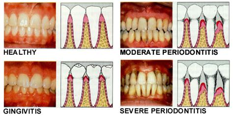 What Is Periodontal Gum Disease Orwigsburg Pennsylvania Sweet Tooth Dental