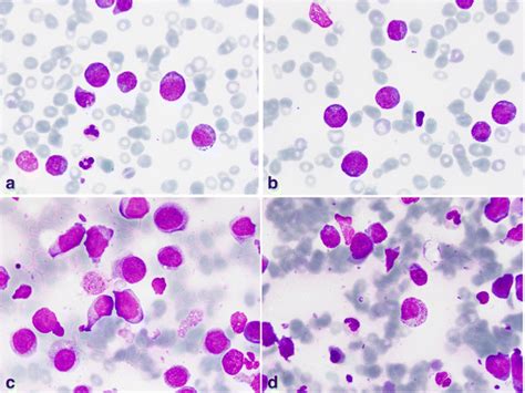 A B Morphological Features On The Peripheral Blood Smear Atypical