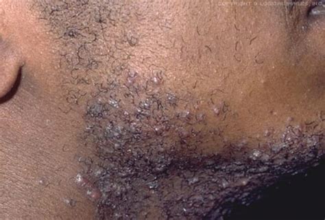 Razor bumps, also called pseudofollicultis barbae, can occur in any area that hair is temporarily removed by shaving, waxing or tweezing. Preventing Ingrown Hair and Razor Bumps for Black Men Shaving