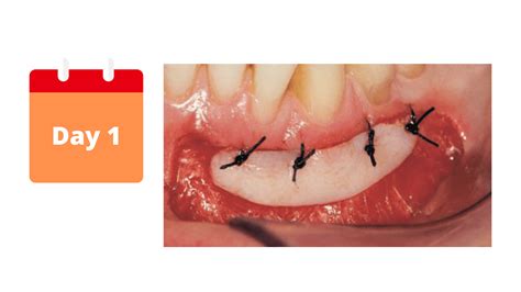 The Different Healing Stages Of A Gum Graft Day By Day Pictures