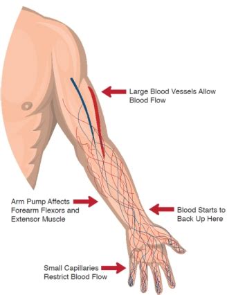 As a former racer unfortunately, that has not happened and folklore at the racetrack runs rampant as to how to prevent getting rock hard forearms. Profile: The HemoFlo Solution to Arm Pump - Fighting ...
