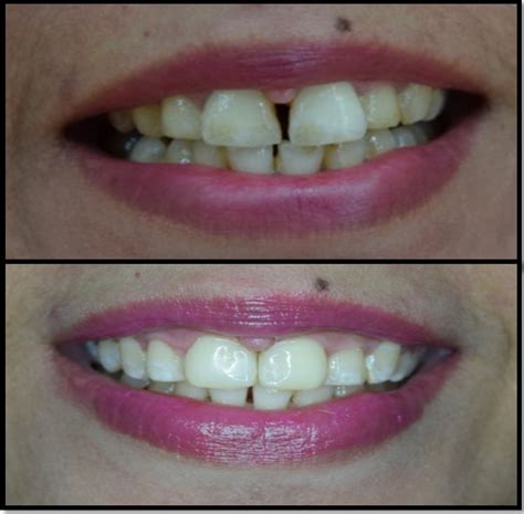 With straight my teeth, you can do everything from home. Now You Can Get Rid of Your Teeth Gap Problems Soon | Gap ...