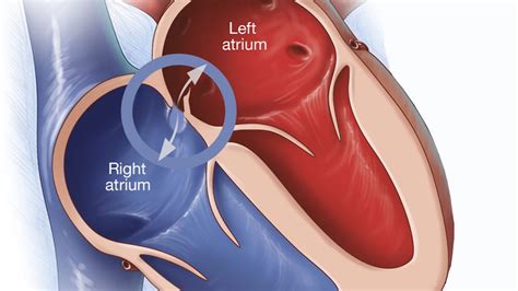 Mayo Clinic Q And A Treatment For Patent Foramen Ovale Mayo Clinic