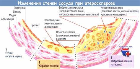 Схема развития атеросклероза Картинка - Схема развития атеросклероза