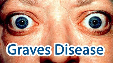 Graves Disease Explained Easy Symptoms Causes Mechanism Treatment