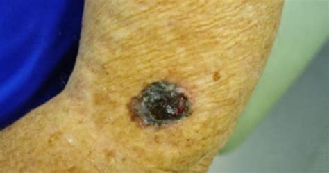 Dermatology For Pharmacists Skin Cancertumours Common Worrying