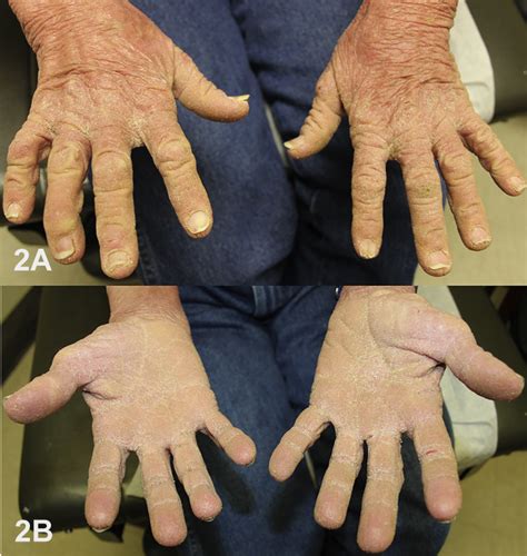 Hyperkeratosis With Visual And Hearing Disturbances Journal Of The