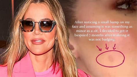 khloé kardashian gives update after removal of facial tumor i m totally ok entertainment
