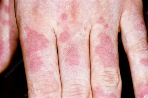 Urticaria Stock Image C0269175 Science Photo Library