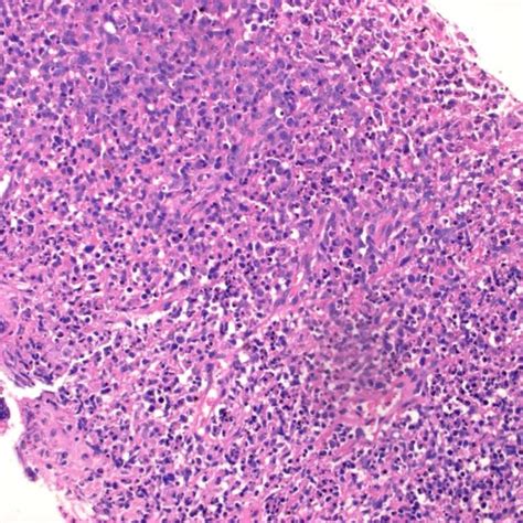 Liver Biopsy Showing Cd20 Positive Diffuse Large B Cell Type Lymphoma