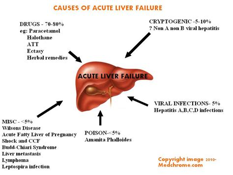 Acute Liver Failure Classification Causes Features And Management