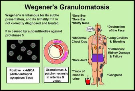 Wegeners Granulomatosis This Was My Mothers Diagnosis At Age 83 It