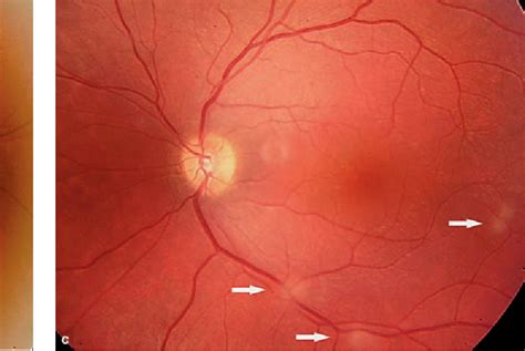 Retinal Hamartoma Tuberous Sclerosis