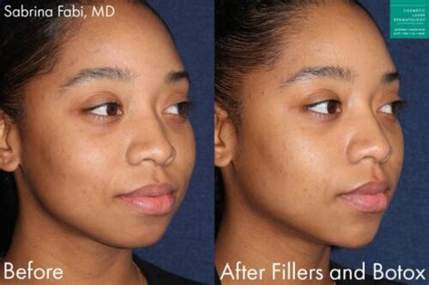 5 Fixes For A Sagging Chin Cosmetic Laser Dermatology Skin